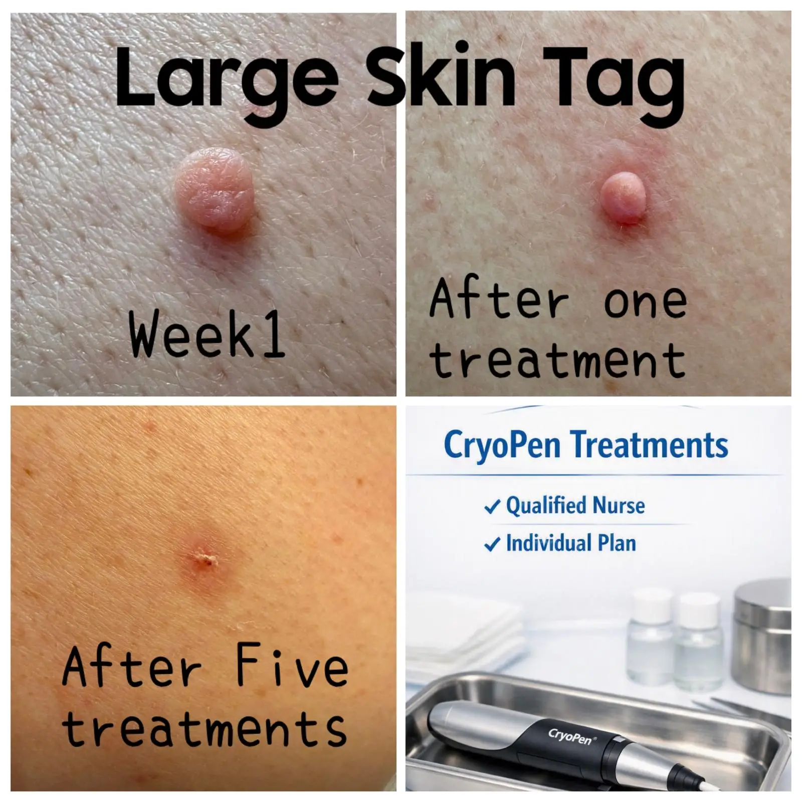 Large skin tag removal — progress across 5 treatments
